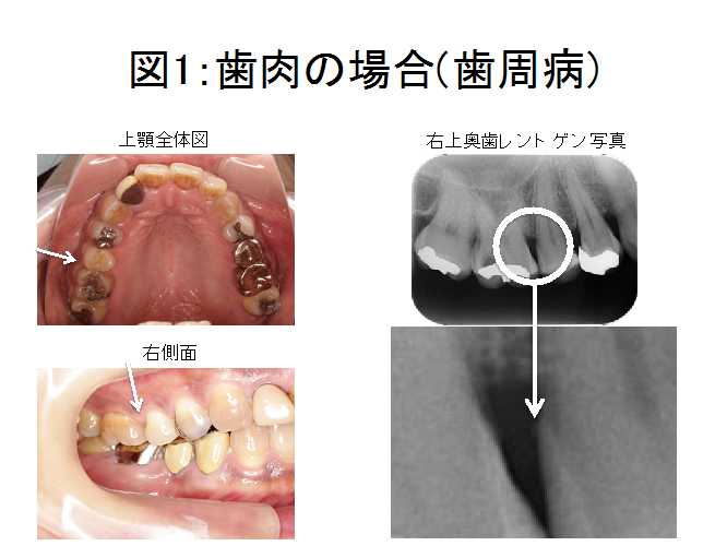 歯が痛い！原因が歯肉の場合