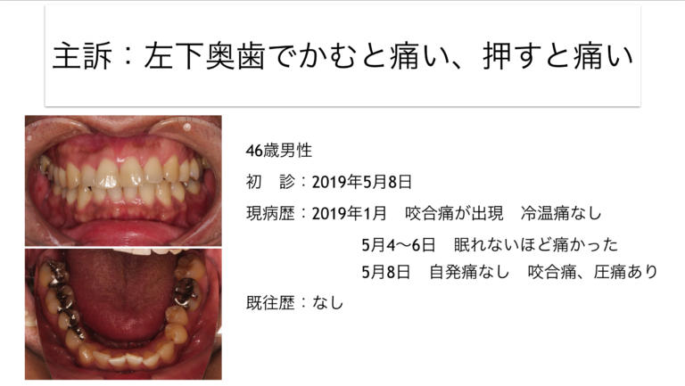 歯髄(歯の神経)は残せるか？残せないか？〜診査診断の大切さ　歯髄壊死編②〜