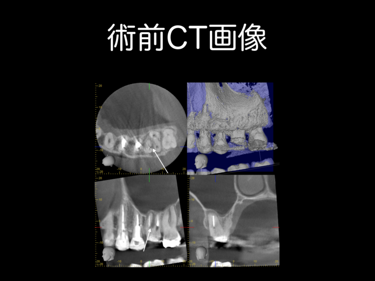 術前CT画像