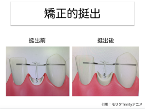 挺出(エクストルージョン)について