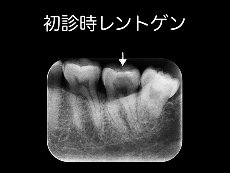 初診時レントゲン