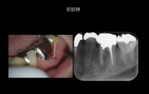 ももこ歯科での根管治療〜サイナストラクトは治るのか〜