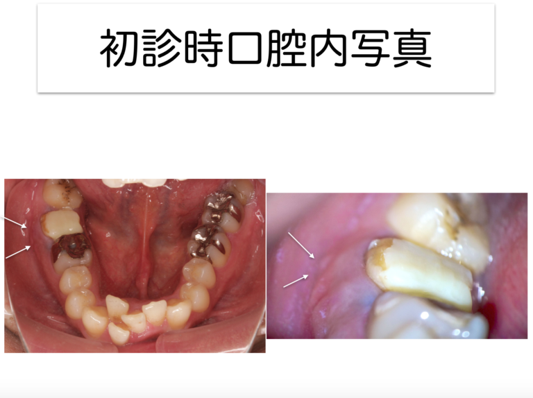 穴があいてる歯は治るか〜part2 根尖部穿孔経過良好編〜