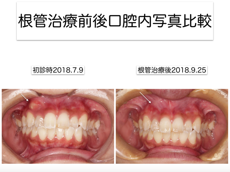 根管治療前後口腔内写真比較