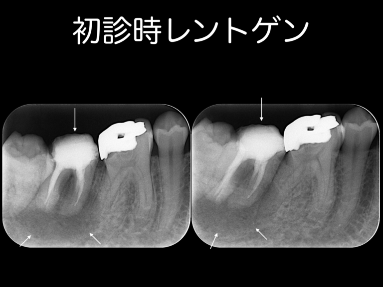 初診時レントゲン