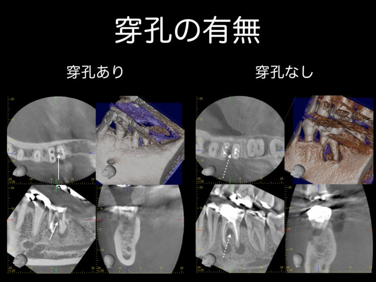 穿孔の有無