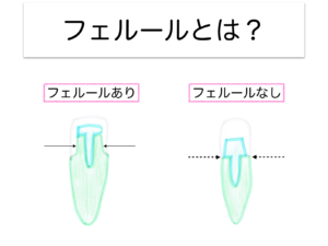 矯正的挺出をなぜ行うか〜フェルールの確保2〜