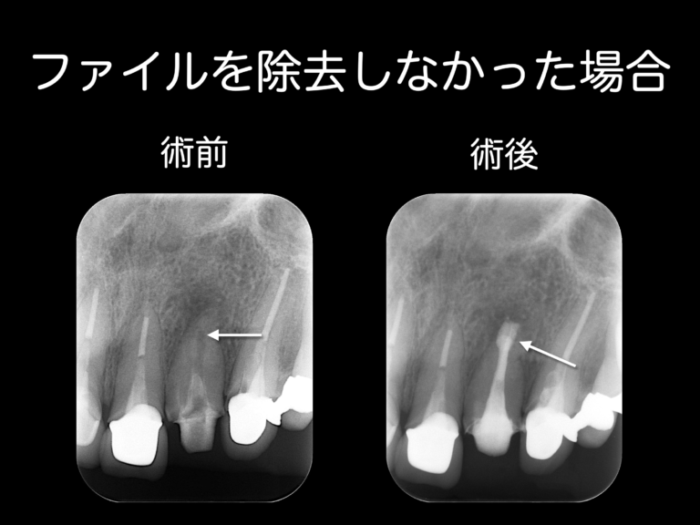 ファイルを除去しなかった場合