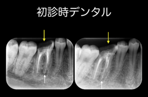 そもそもその歯に根管治療は必要か？〜パート２〜