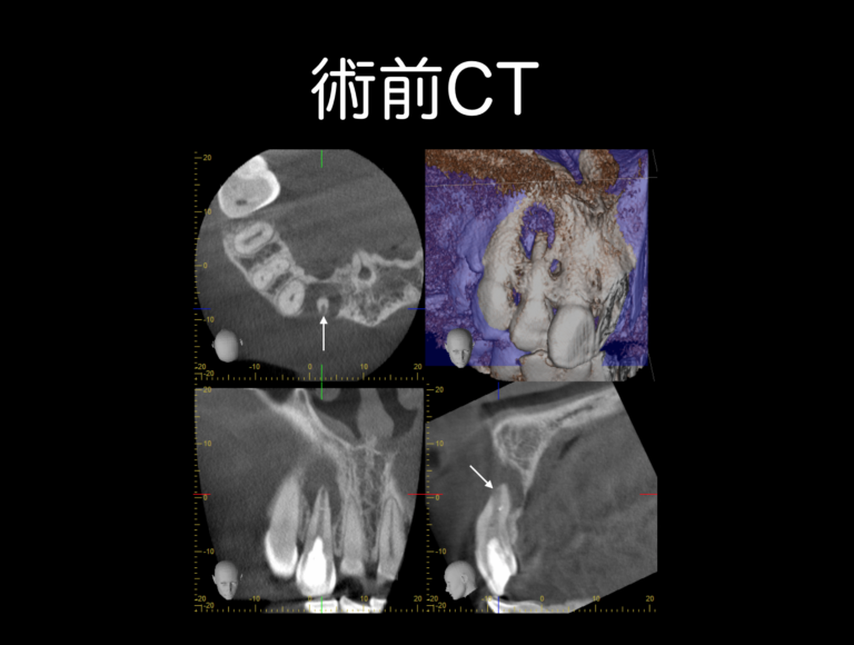 術前CT