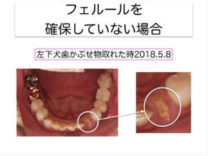 矯正的挺出をなぜ行うか〜フェルールの確保1〜