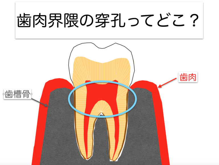 穴があいてる歯は治るか？