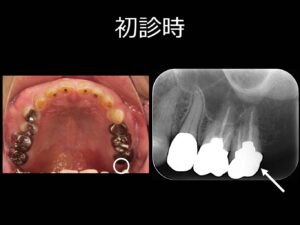 根管治療にCTは必要でしょうか？？ ～パート２～