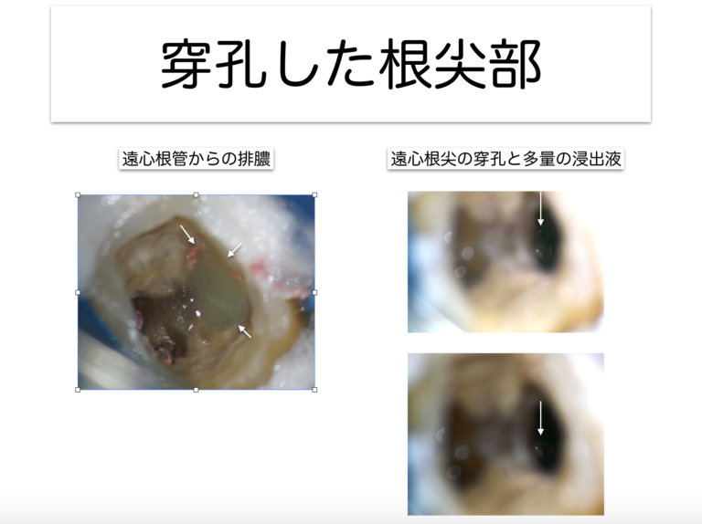 穿孔した根尖部