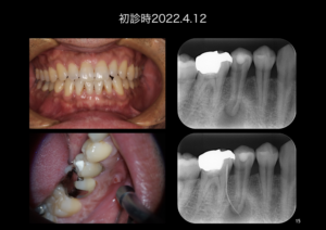 ももこ歯科での根管治療４〜サイナストラクトは治るのか 症例３〜