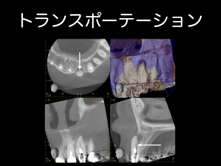 根管の中で折れたファイルをどうすればいい？〜ファイルを取らない時〜