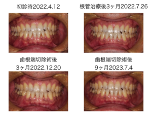 ももこ歯科での根管治療５〜サイナストラクトは治るのか 症例３歯根端切除術編〜