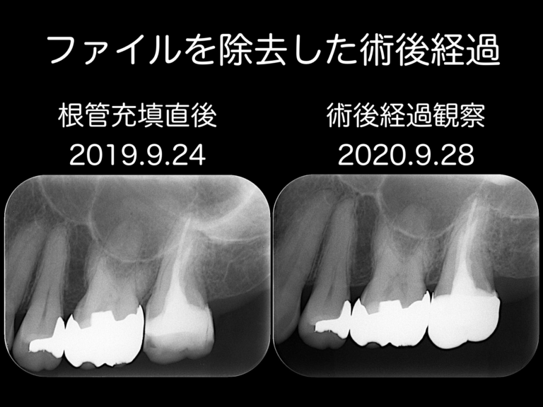 術後経過