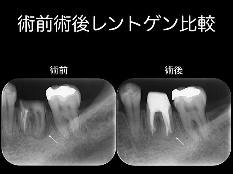 根管治療で痛みが取れないと抜歯しなければいけないか？