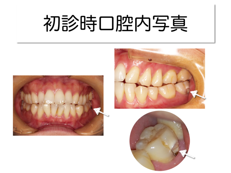 初診時口腔内写真