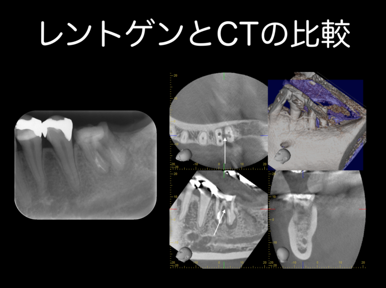 レントゲントCTの比較