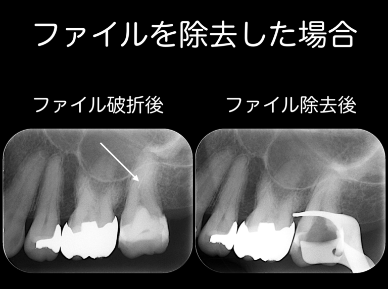 折れたファイルを取るべきかどうか〜ファイルを取る意思決定〜