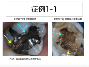 歯をもたせるための、豆知識〜その3 虫歯編②〜