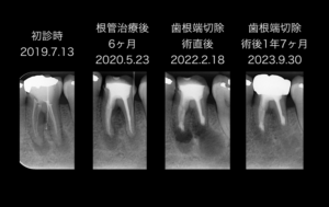 ももこ歯科での根管治療8〜サイナストラクトは治るのか 症例４歯内歯周病変編〜