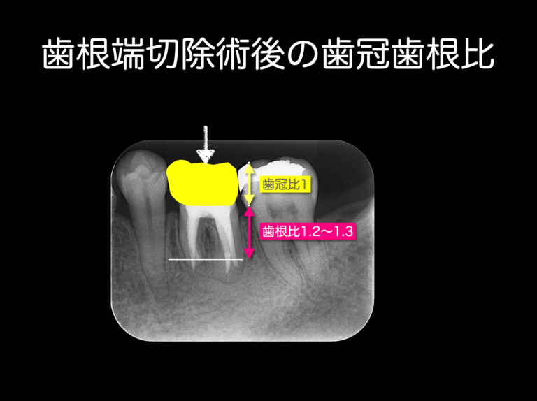 歯根端切除術