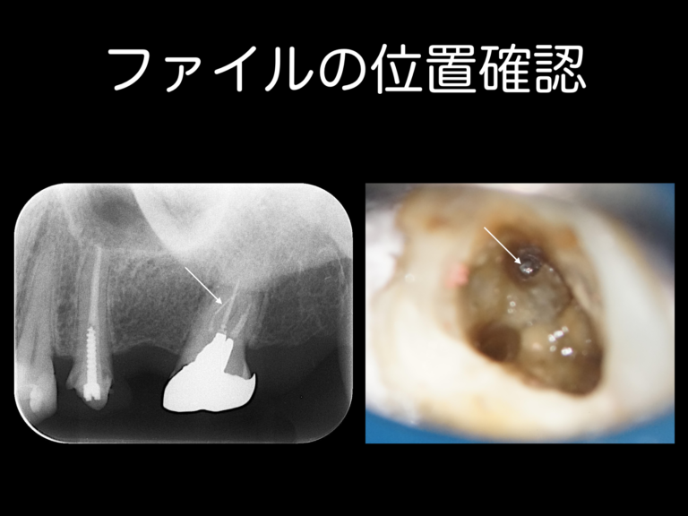 折れたファイルを取るべきかどうか〜意思決定について〜